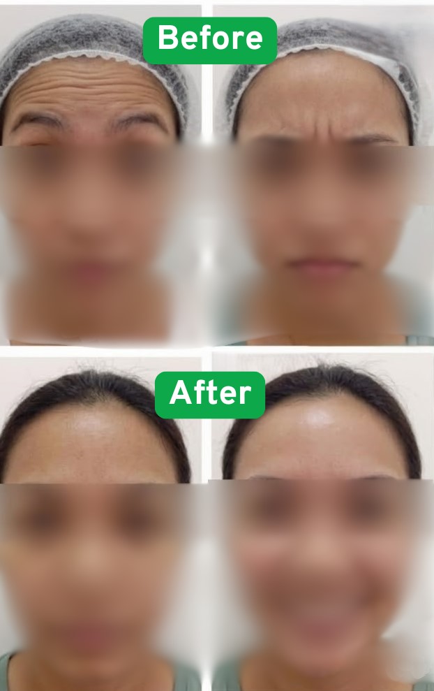 Botox before and after — forehead wrinkle treatment