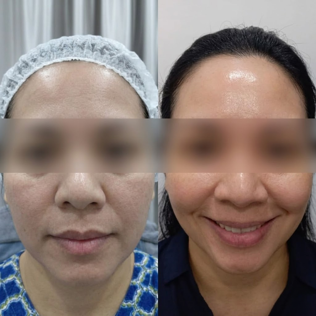 Botox facial rejuvenation before and after