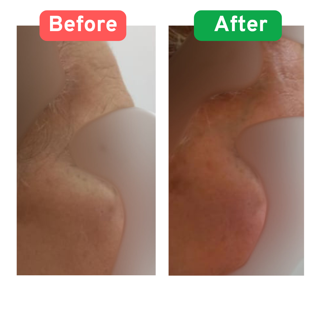 Botox treatment before and after results