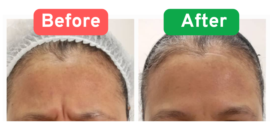 Botox treatment before and after results