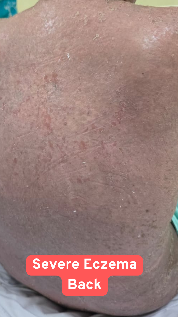 Severe eczema before treatment